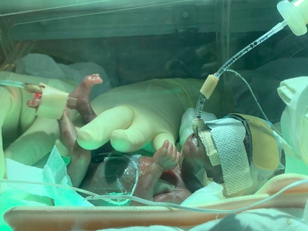 태어난 지 4일째 된 건우가 인큐베이터에서 치료를 받고 있는 모습. /서울 아산병원