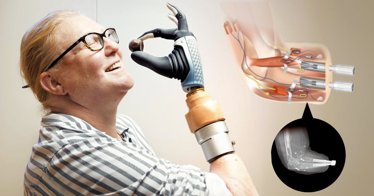 Bionic Prosthetic Hand Technology: Success Stories and Future Developments