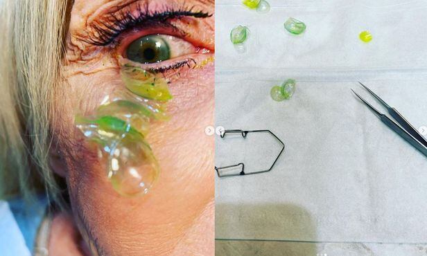 한 70대 미국 여성 눈에서 발견된 콘택트 렌즈. 발견된 렌즈 개수만 23개였다. /카테리나 쿠르티바 인스타그램