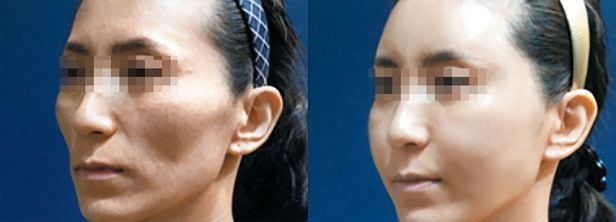 서울 시내 한 병원이 최근 진행한 줄기세포얼굴지방이식 수술 전(왼쪽) 모습과 수술 후 2주가 지난 모습. 얼굴 입체감이 살아난 것을 확인할 수 있다./조선일보 DB