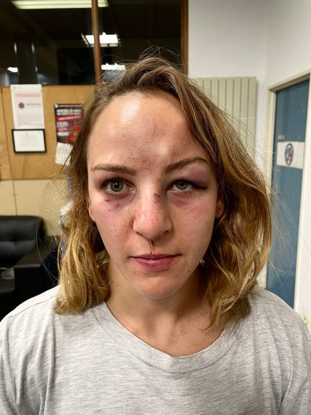 프랑스의 여자 유도 선수 마르고 피노가 가정폭력을 당했다며 자신의 트위터에 공개한 얼굴 사진./트위터