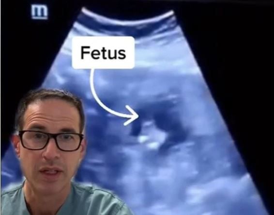 캐나다 의사가 공개한 '간 자궁외임신' 초음파 영상./틱톡
