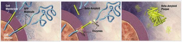 알츠하이머 치매 발생 과정. 베타 아밀로이드(노란색) 단백질은 원래 신경세포를 보호하지만(왼족 그림), 세포에서 떨어져 나와(가운데) 덩어리를 형성하면(오른쪽) 오히려 신경세포를 손상시켜 알츠하이머 치매를 부른다./NIH