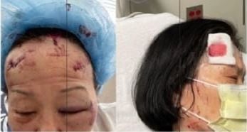 볼티모어에서 괴한 습격을 받은 여성들의 상처. 한 여성은 33바늘을  꿰맸다./만나24캡처