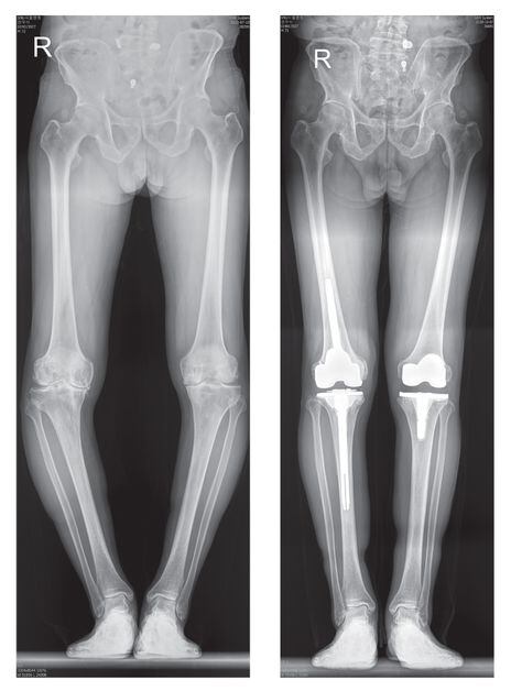 말기 퇴행성관절염 환자의 휜 다리(왼쪽 사진)와 인공관절 전치환술 후 곧게 뻗은 다리. / SNU서울병원 제공