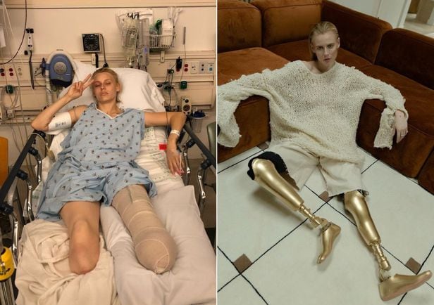 2012년 독성쇼크증후군으로 양다리를 절단하는 수술을 받은 유명 모델 로렌 바서(35). /인스타그램