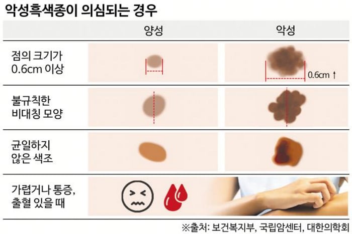 가장 위험한 피부암, 악성흑색종 - 조선일보
